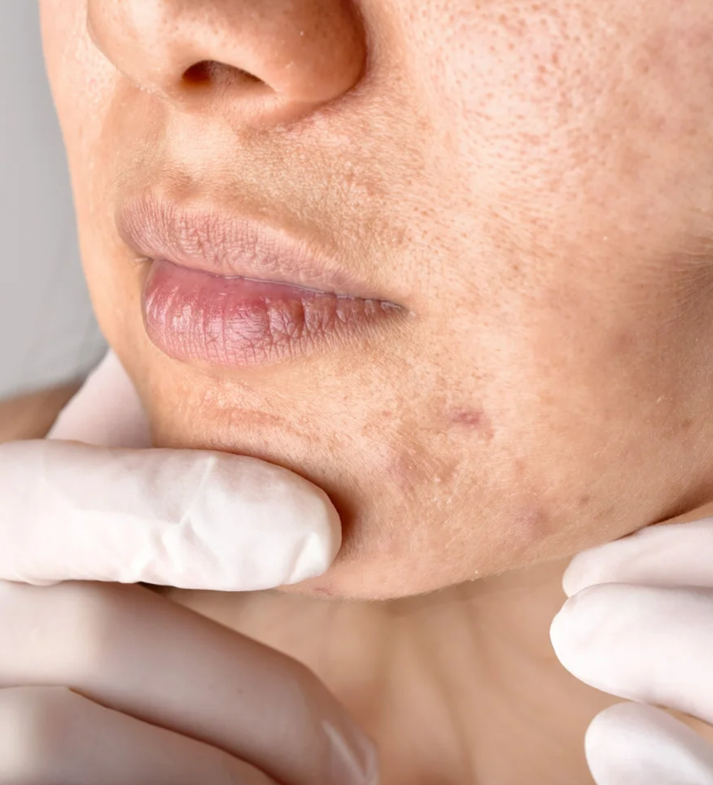 Tratamento para Melasma imagem