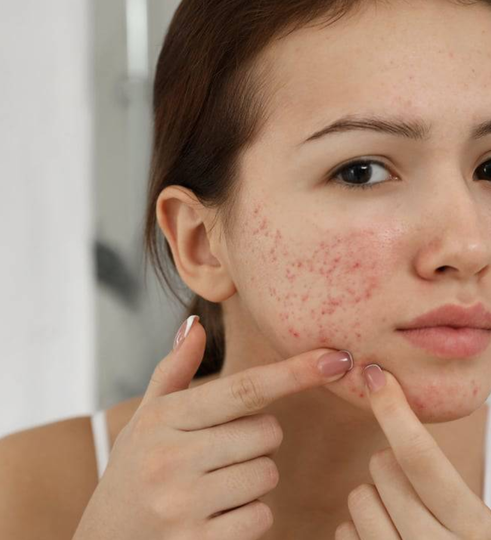 tratamento para acne imagem